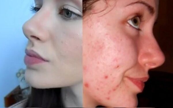 Neįtikėtina makiažo galia: kaip užmaskuoti spuogus (video)