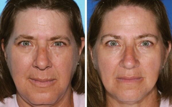 Rūkymo žala geriausiai atsispindi dvynių veiduose (foto)