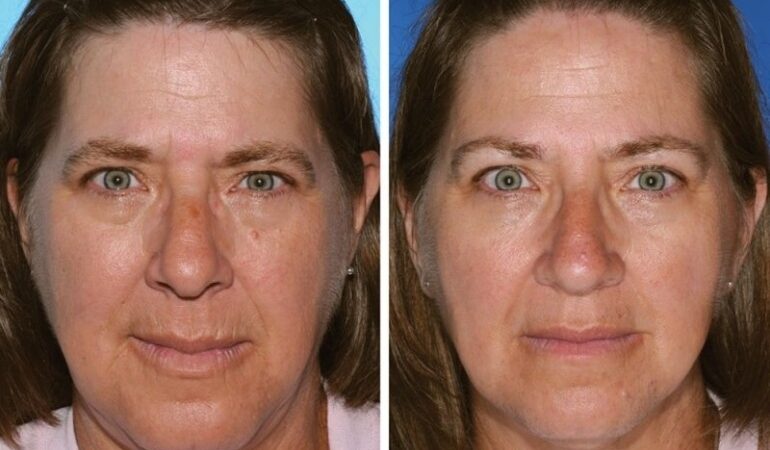 Rūkymo žala geriausiai atsispindi dvynių veiduose (foto)