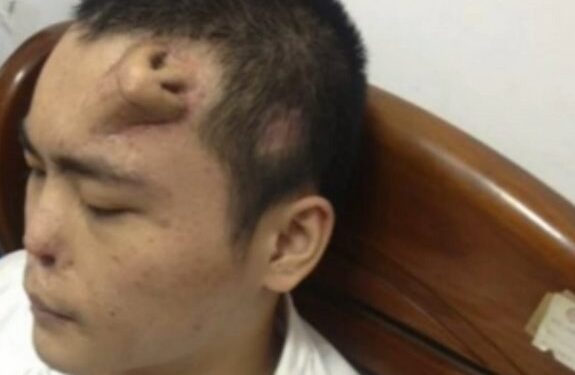 Jaunuoliui ant kaktos užauginta antra nosis (video)