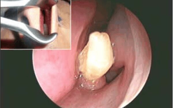 Gydytojai jaunuolio nosyje rado išdygusį dantį (foto)