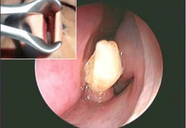 Gydytojai jaunuolio nosyje rado išdygusį dantį (foto)