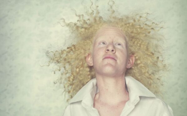 Sergantieji albinizmu – žmonės ir gyvūnai (foto)