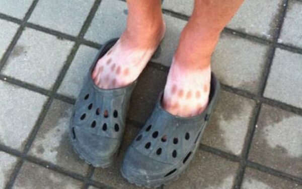 Skausmingi saulės vonių pokštai (foto)