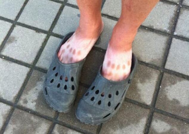 Skausmingi saulės vonių pokštai (foto)