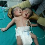 Indijoje gimė dvigalvis kūdikis (foto