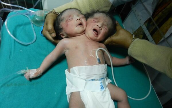 Indijoje gimė dvigalvis kūdikis (foto, video)