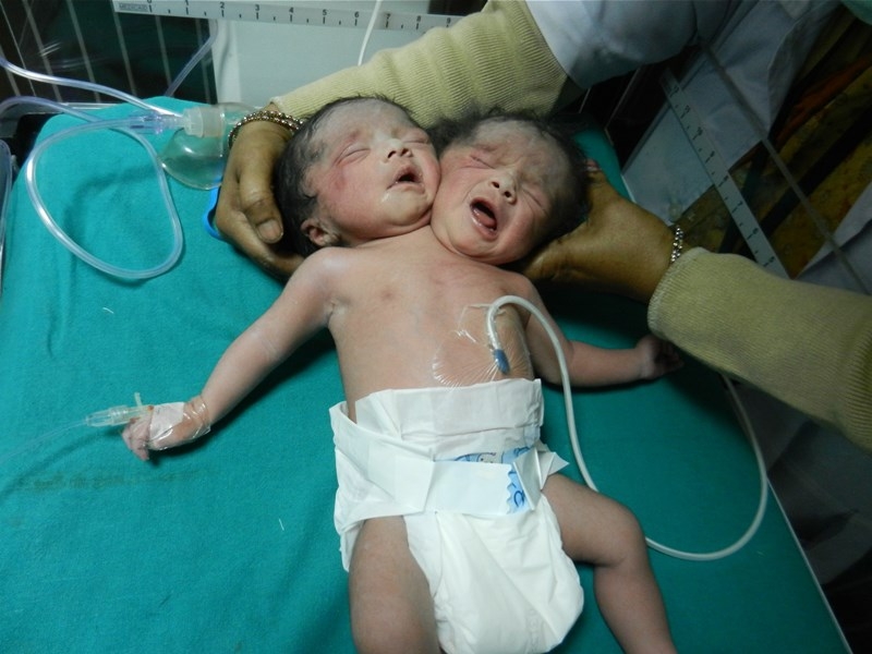 Indijoje gimė dvigalvis kūdikis (foto
