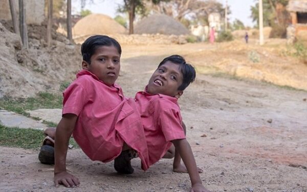 Sunkus gyvenimas. Siamo dvyniai, kuriuos garbina visas kaimas (foto)