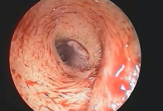 Neįtikėtina: moters ausyje rasta musių lervų (video)