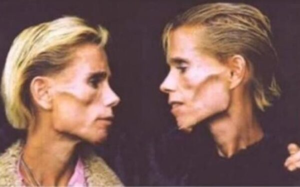 Likimo ironija – identiškų dvynių kovą su anoreksija nutraukė gaisras