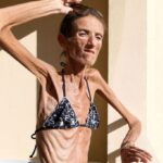 Skaudi anoreksija sergančiosios istorija: mama ribojo maistą