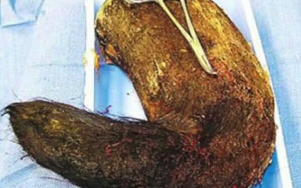 Iš merginos skrandžio pašalintas beveik 2 kg plaukų gniužulas