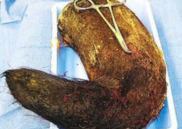 Iš merginos skrandžio pašalintas beveik 2 kg plaukų gniužulas