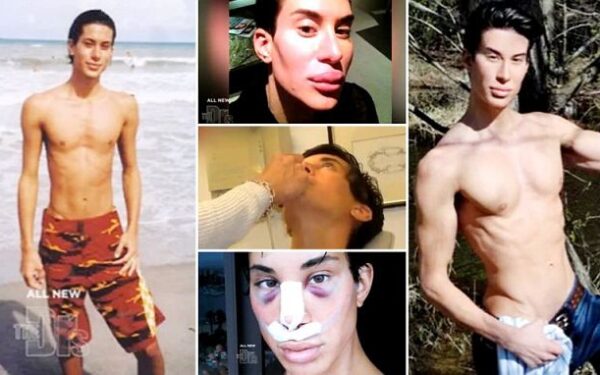 Plastinių operacijų manija: vaikinas, siekiantis tapti gyvu Barbės vyru Kenu (foto)