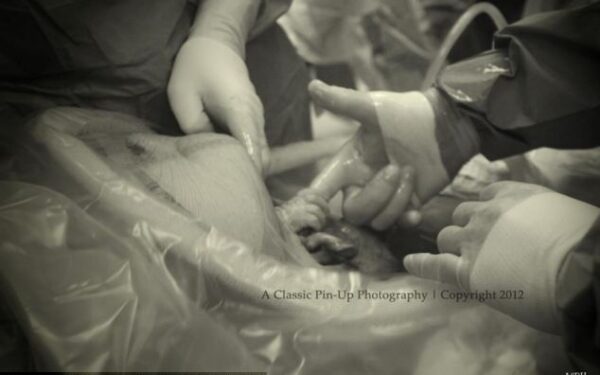 Unikalus kadras – gimdymo metu kūdikis sučiupo daktaro pirštą (foto)