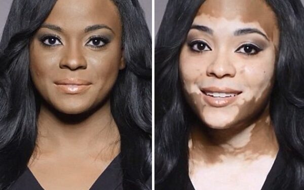 Video pusryčiai. Mergina kosmetikos reklamoje prisipažįsta apie sunkią odos ligą (video)