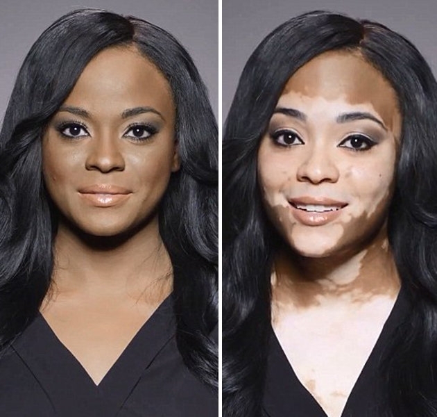 Video pusryčiai. Mergina kosmetikos reklamoje prisipažįsta apie sunkią odos ligą (video)