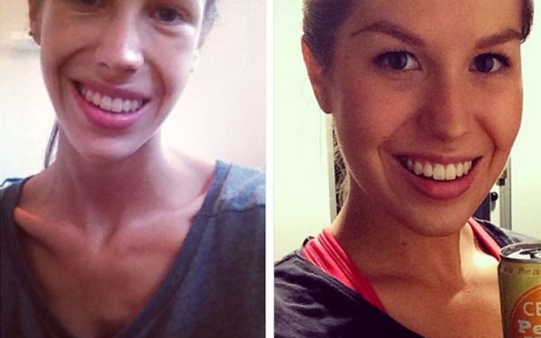 Pasprukimas nuo mirties: anoreksijos auka nuotraukose fiksuoja savo sveikimo istoriją (foto)