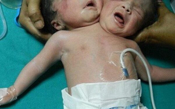 Indijoje gimė Siamo dvynės