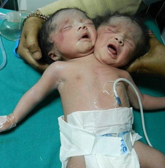 Indijoje gimė Siamo dvynės