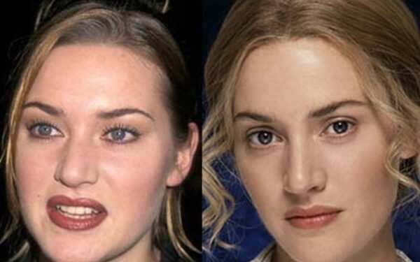 Kažkas čia ne taip. Įžymybės po nosies korekcijos (foto)