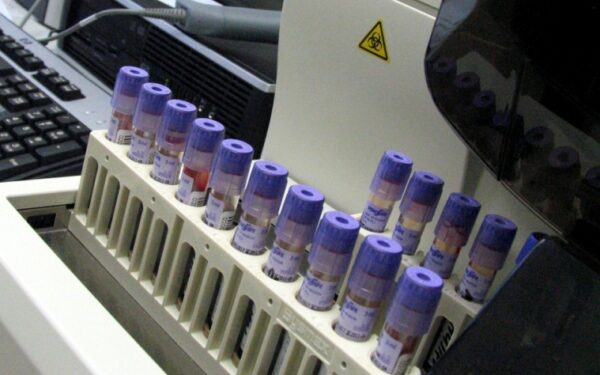 Anemija arba kai norisi užkrimsti kreidos