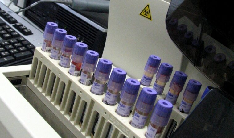 Anemija arba kai norisi užkrimsti kreidos