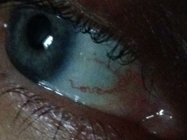 Būna ir taip: moters akies obuolyje kraujagyslės sudėliojo žodį „Meilė“ (video)