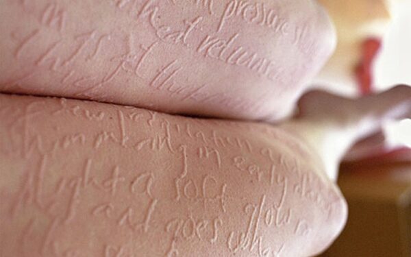 Kai trūkumai tampa pranašumais arba kai labai labai jautri oda tampa menu (foto)