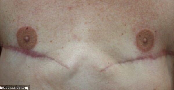 Amerikietis, tatuiruojantis spenelius moterims, kurioms buvo pašalintos krūtys (foto)