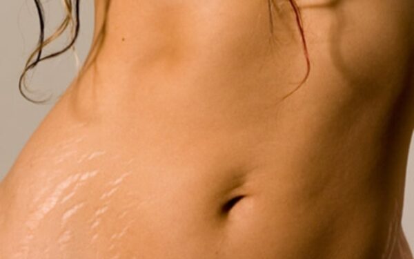 Strijos: kuo anksčiau bus pradėtos gydyti, tuo greičiau taps mažiau pastebimos