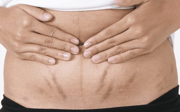 Strijos – priešas, su kuriuo kovoti reikia nedelsiant