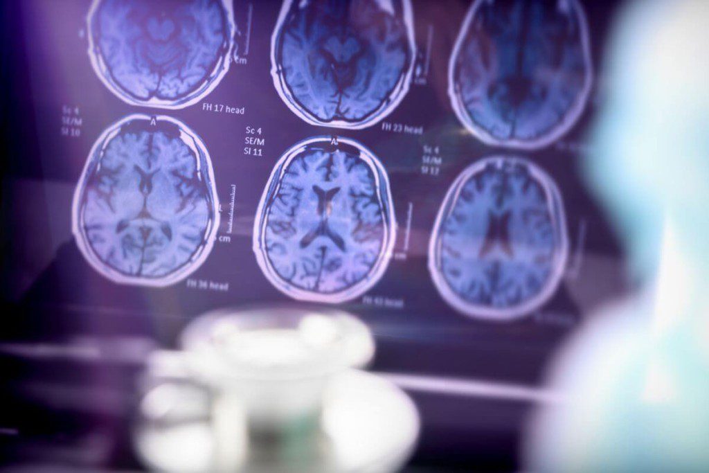 alzheimerio-ligos-pozymiai-uosles-praradimas - Laikas.lt Alzheimerio ligos požymiai: uoslės praradimas