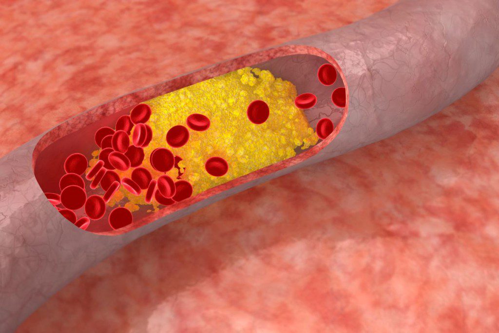 pagrindiniai-tyrimo-rezultatai-rysys-tarp-cholesterolio-ir-demencijos - Laikas.lt Pagrindiniai tyrimo rezultatai: ryšys tarp cholesterolio ir demencijos