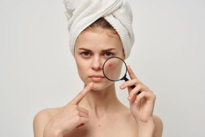 Veido aknė: dermatologė įvardijo pagrindines priežastis