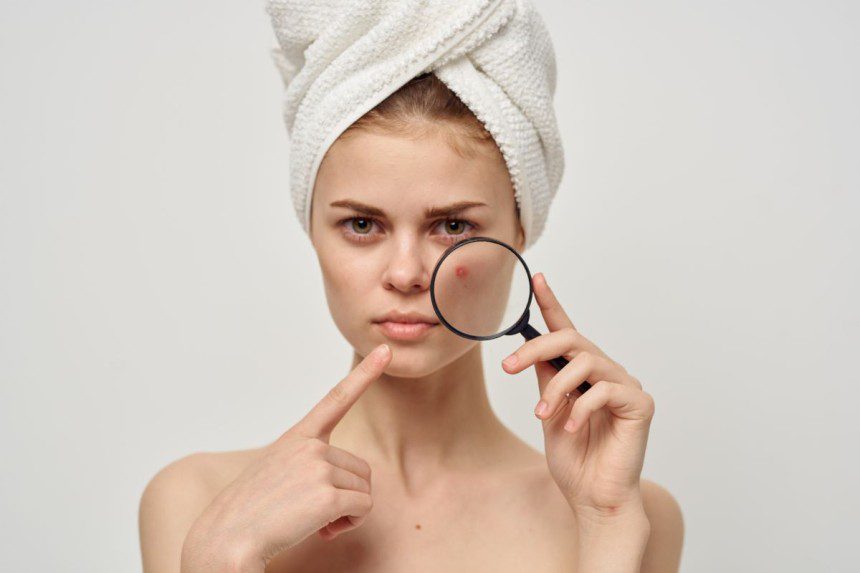 Veido aknė: dermatologė įvardijo pagrindines priežastis