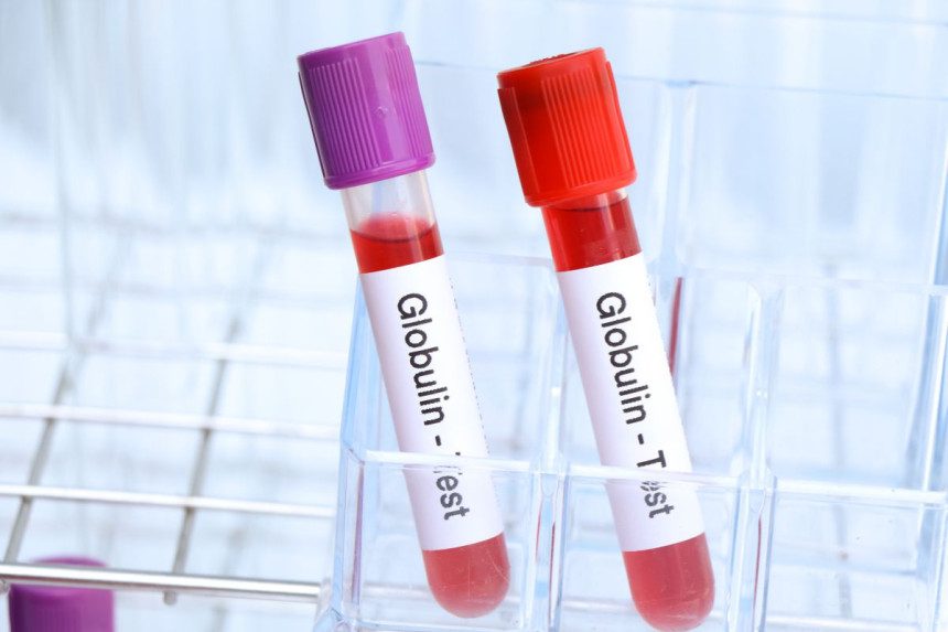 Lytinius hormonus sujungiantis globulinas – kodėl jis svarbus jūsų sveikatai?