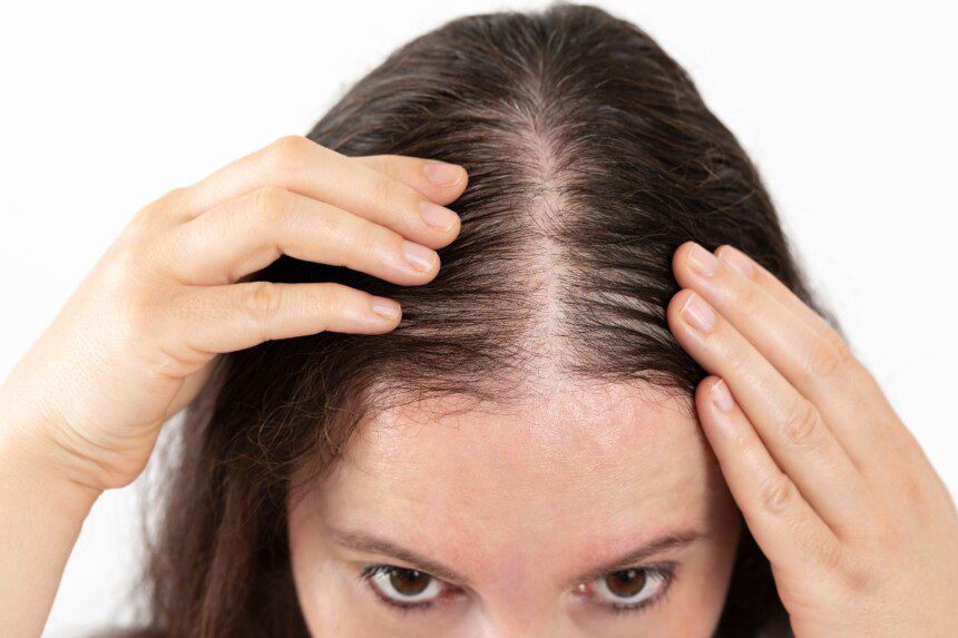 Plaukų slinkimas: ką reikia žinoti ir kada kreiptis į trichologą