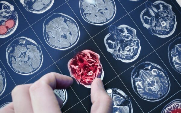 Diagnostikos perversmas: kraujo lašas iš piršto gali atskleisti Alzheimerio požymius