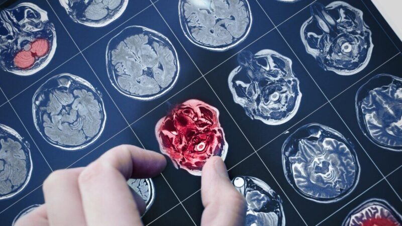 Diagnostikos perversmas: kraujo lašas iš piršto gali atskleisti Alzheimerio požymius