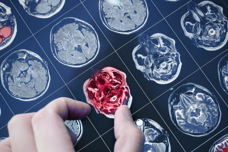 Diagnostikos perversmas: kraujo lašas iš piršto gali atskleisti Alzheimerio požymius