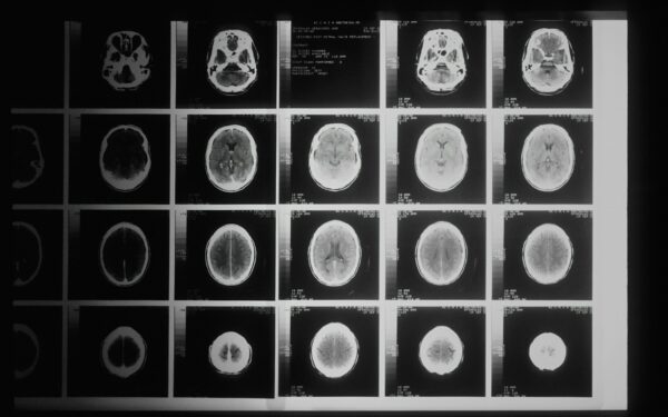 Didžiausia neurologijos klaida: atlikti Alzheimerio ligos tyrimai sukėlė milžinišką skandalą