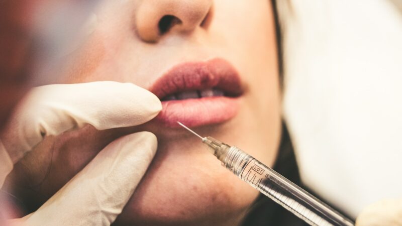 Gydytojai įspėja dėl pasekmių: įvardinti 4 pavojingi atvejai, kai būtina skubiai tirpdyti lūpų ﬁlerį