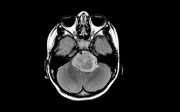 Pabaiga agresyviam šalutiniam poveikiui: lenkų mokslininkų proveržis keičia vėžio gydymą