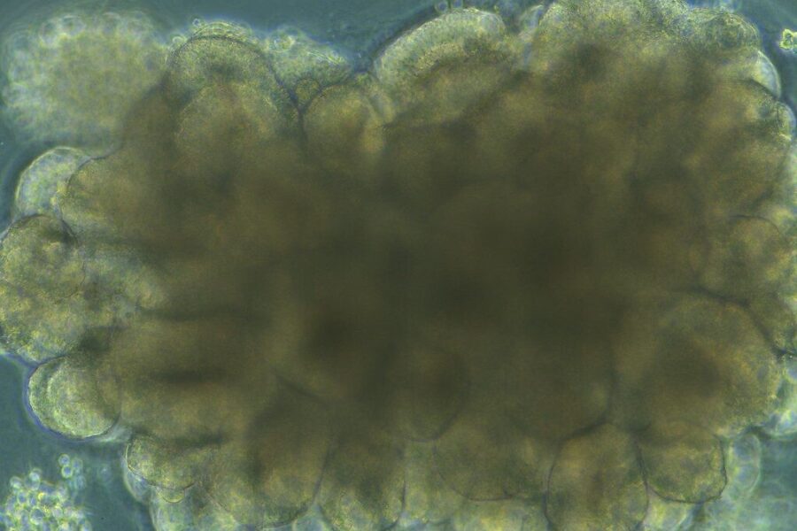 Paralyžiaus gydyme įsižiebė nauja viltis: mokslininkai išbandė intriguojančią žmonių terapiją