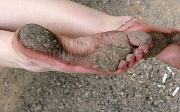 Ilgai išliekantys odos pakitimai: sužinokite, kaip prižiūrėti randus, nuospaudas ir sudegimus