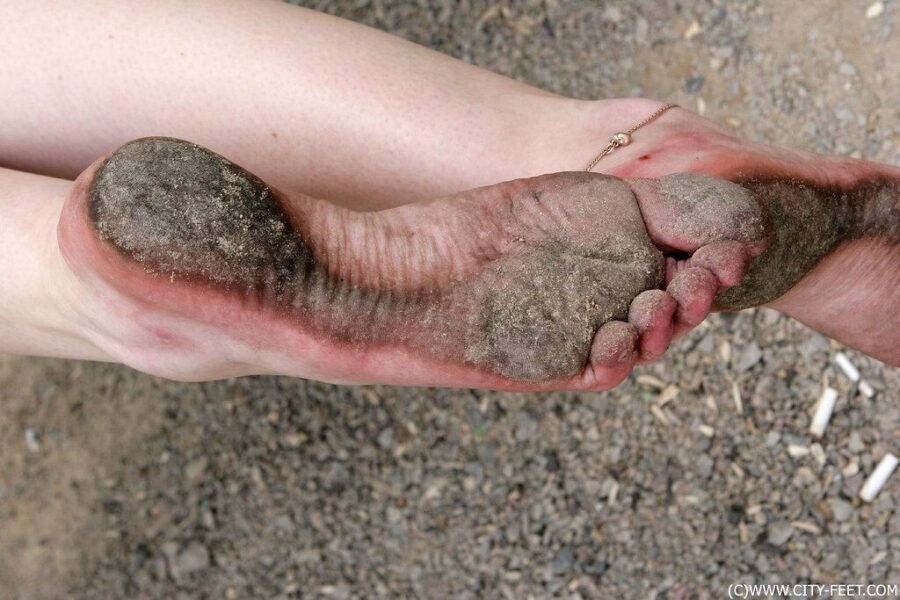 Ilgai išliekantys odos pakitimai: sužinokite, kaip prižiūrėti randus, nuospaudas ir sudegimus