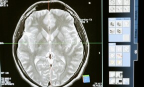 Intricate MRI brain scan displayed on a computer screen for medical analysis and diagnosis.