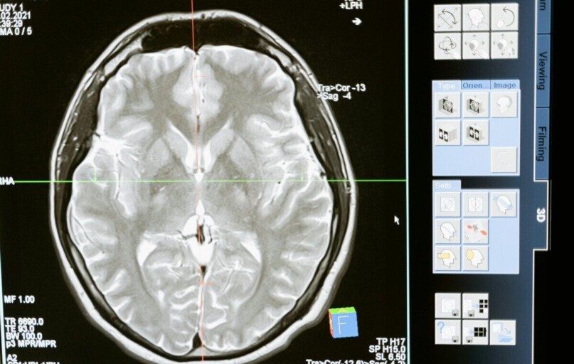 Intricate MRI brain scan displayed on a computer screen for medical analysis and diagnosis.